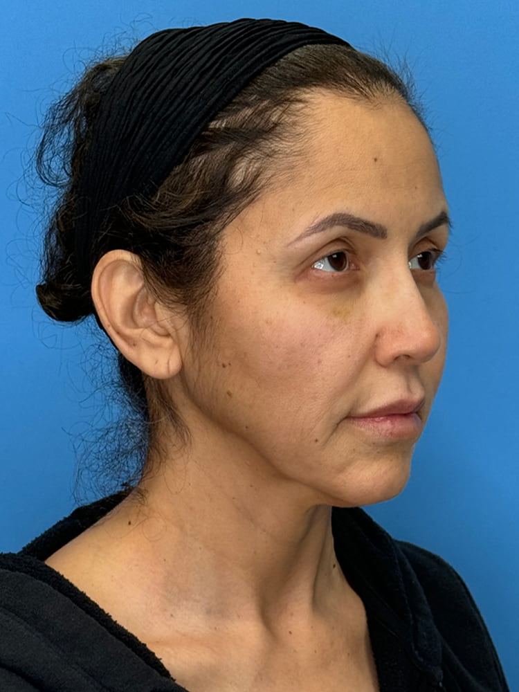 Facelift Before & After Image