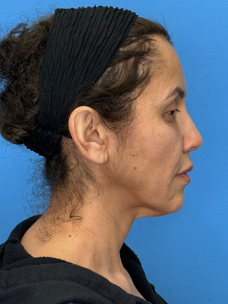 Facelift Before & After Image