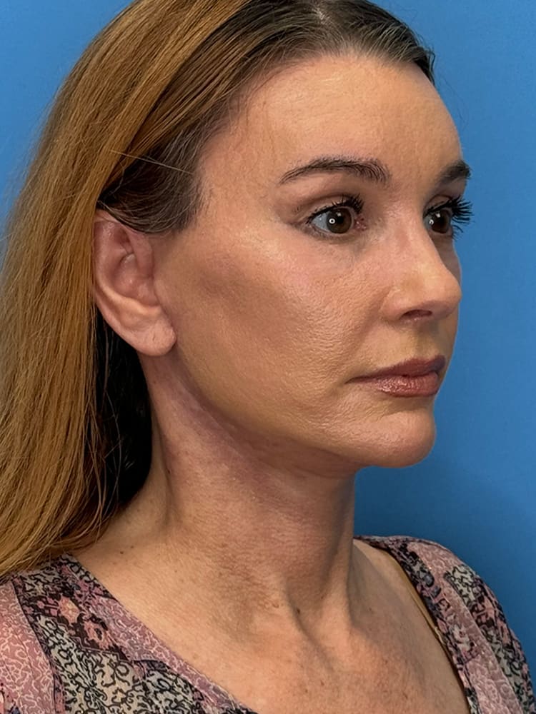 Facelift Before & After Image