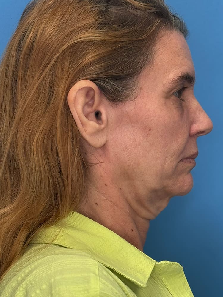 Facelift Before & After Image