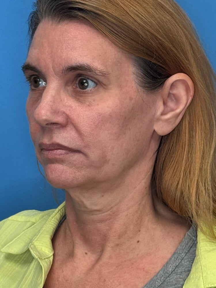 Facelift Before & After Image