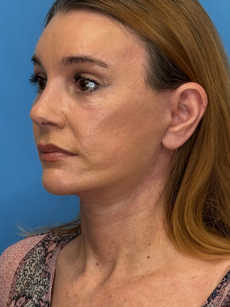 Facelift Before & After Image
