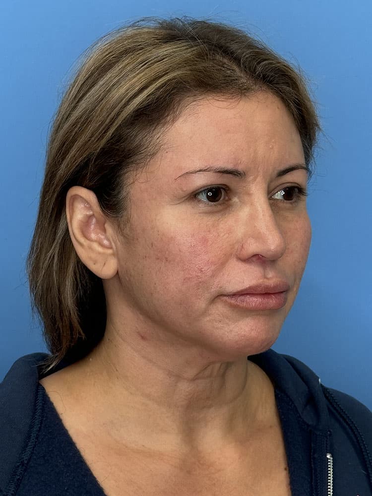 Facelift Before & After Image