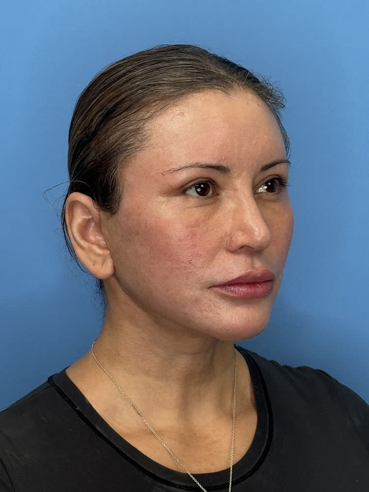 Facelift Before & After Image