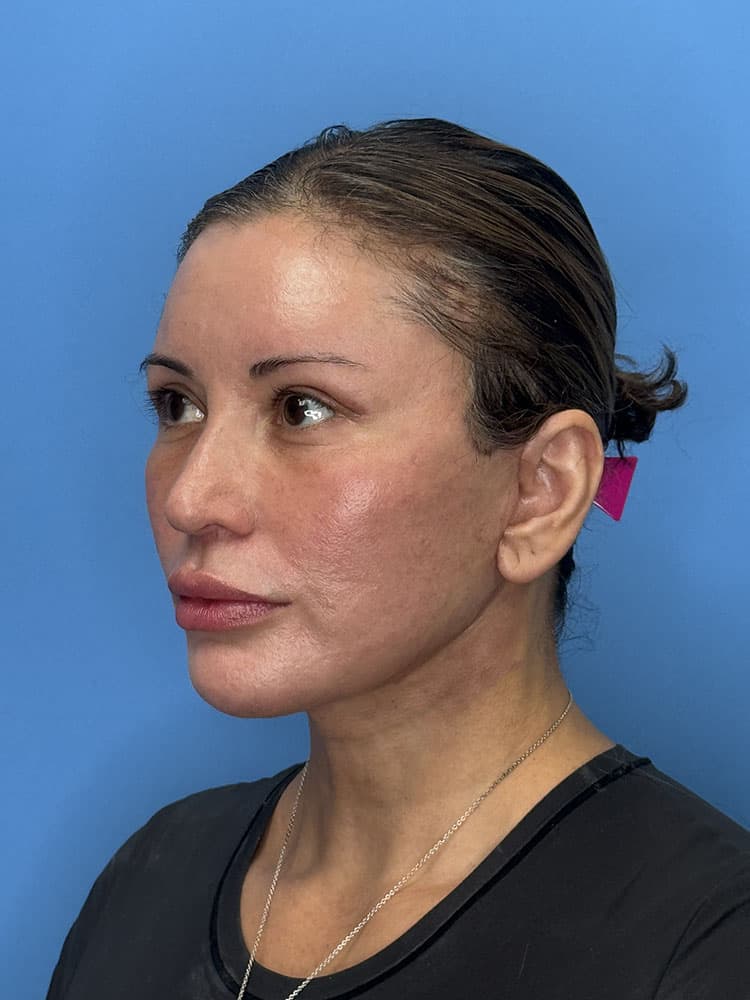 Facelift Before & After Image