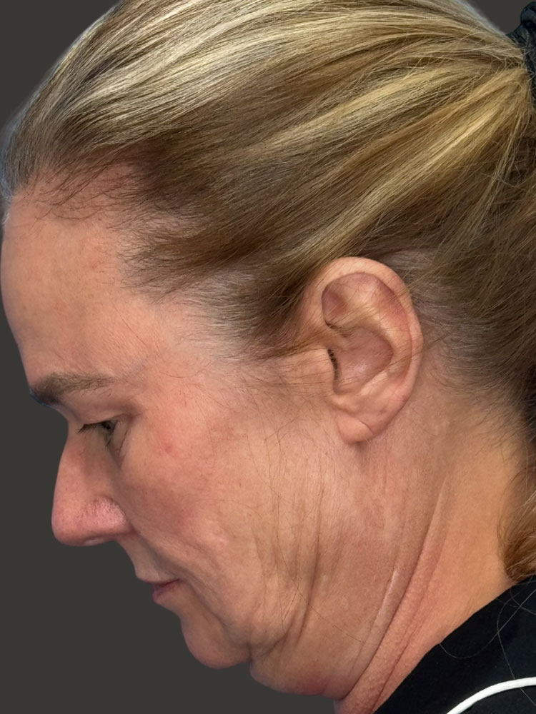 Facelift Before & After Image