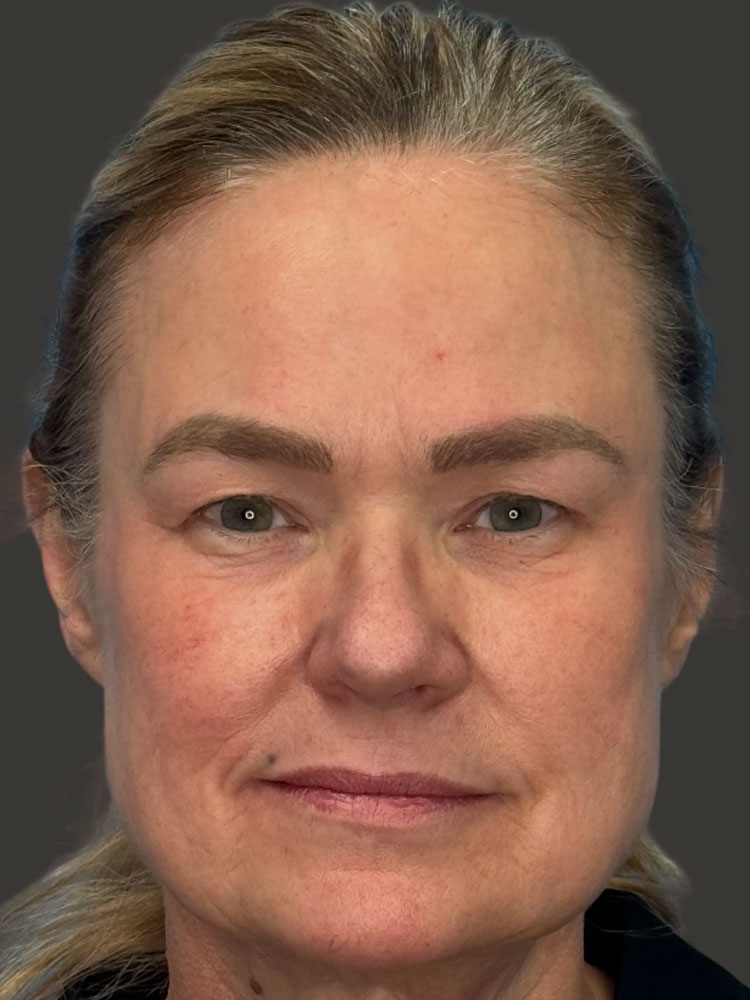 Facelift Before & After Image