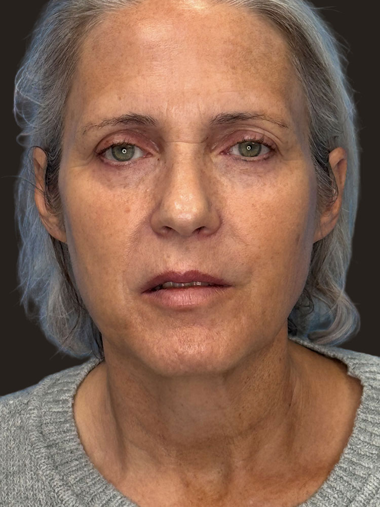 Facelift Before & After Image