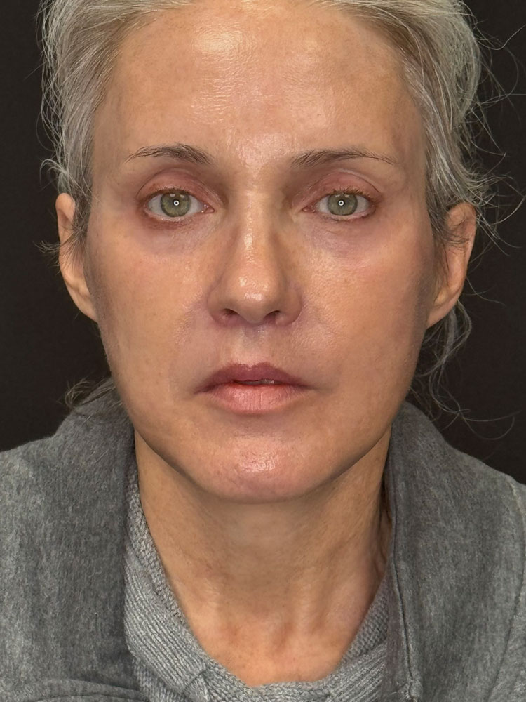 Facelift Before & After Image