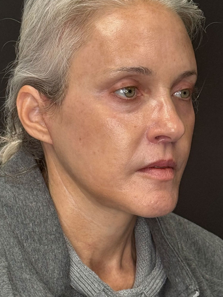 Facelift Before & After Image