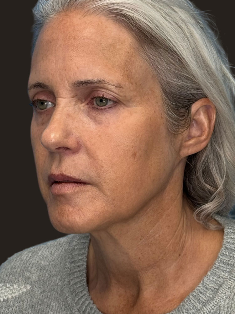 Facelift Before & After Image