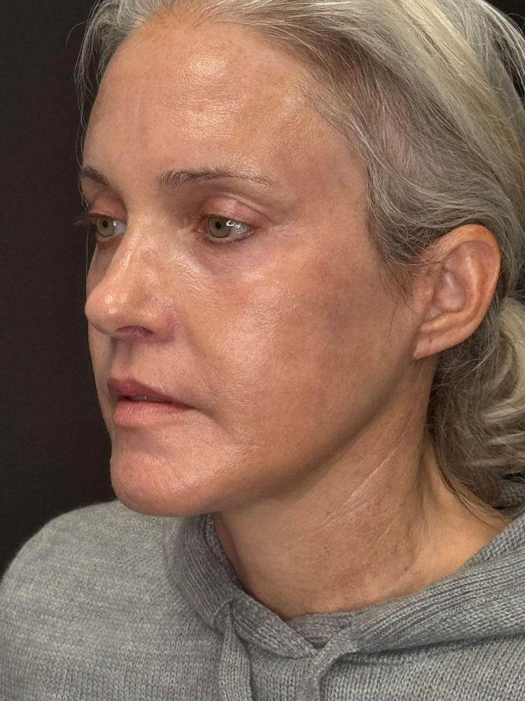 Facelift Before & After Image