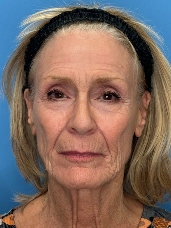 Facelift Before & After Image