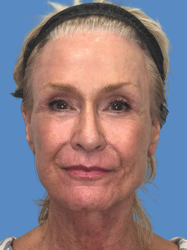 Facelift Before & After Image