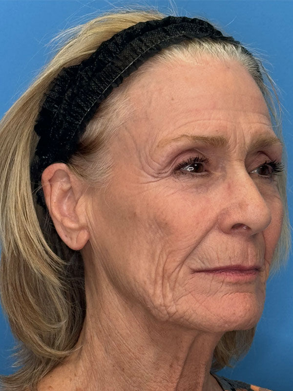 Facelift Before & After Image