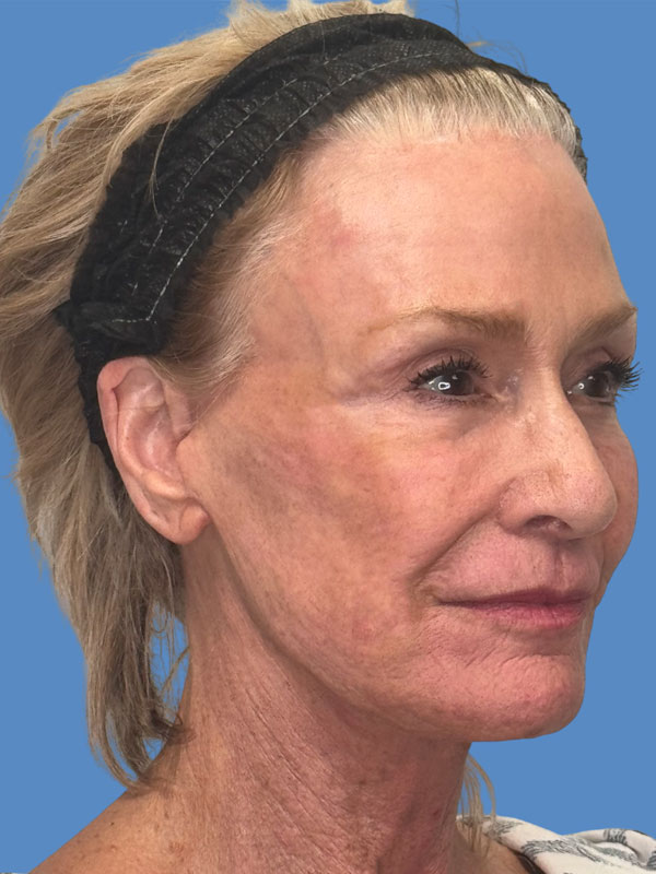 Facelift Before & After Image