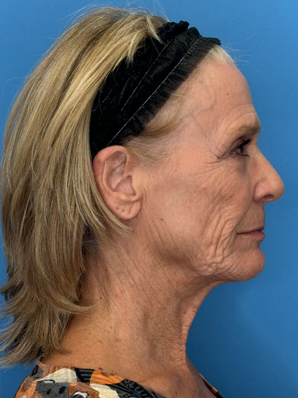 Facelift Before & After Image