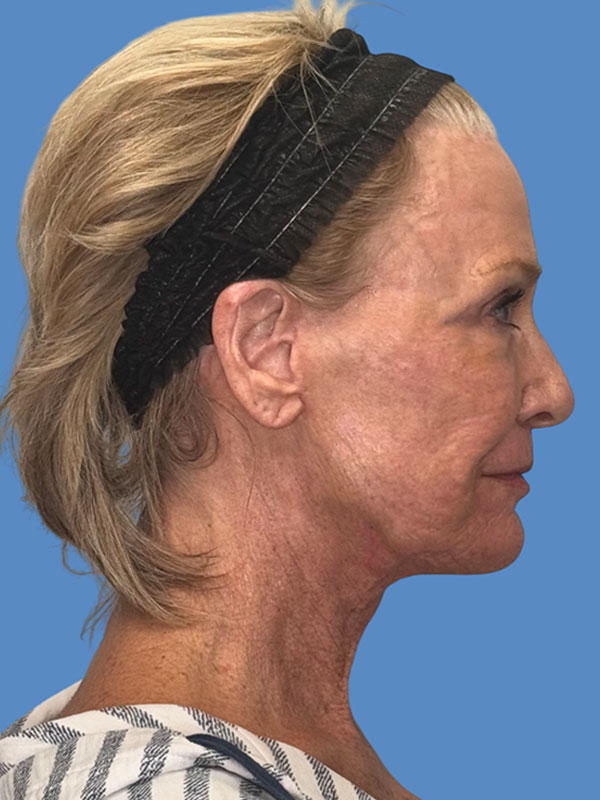 Facelift Before & After Image