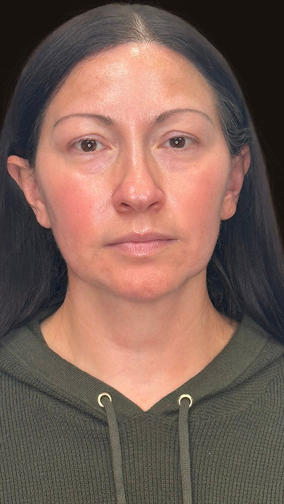 Facelift Before & After Image