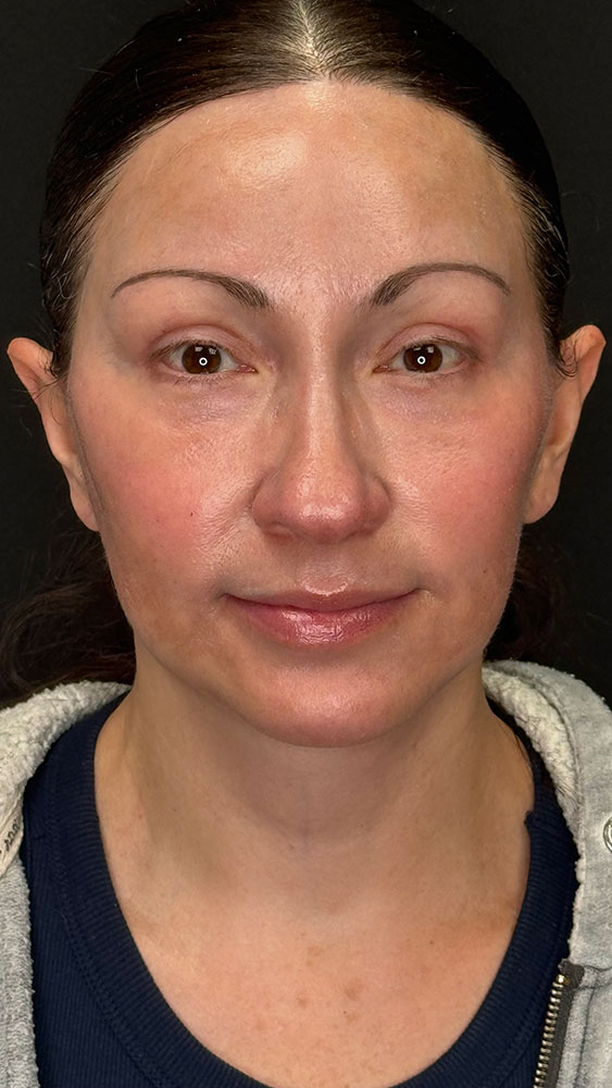 Facelift Before & After Image