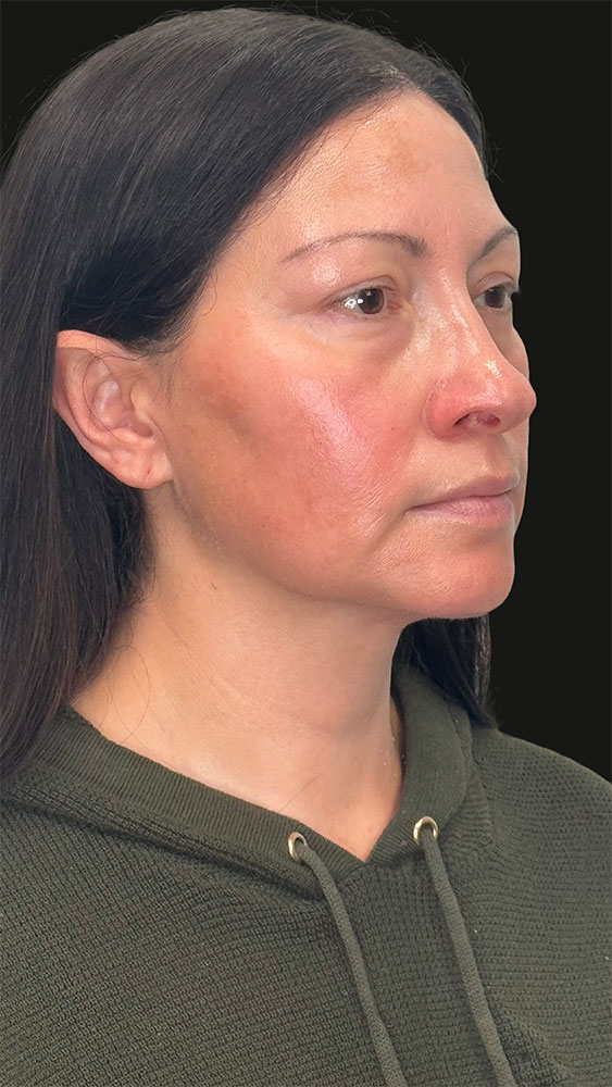 Facelift Before & After Image