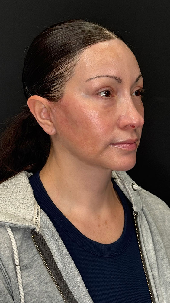 Facelift Before & After Image