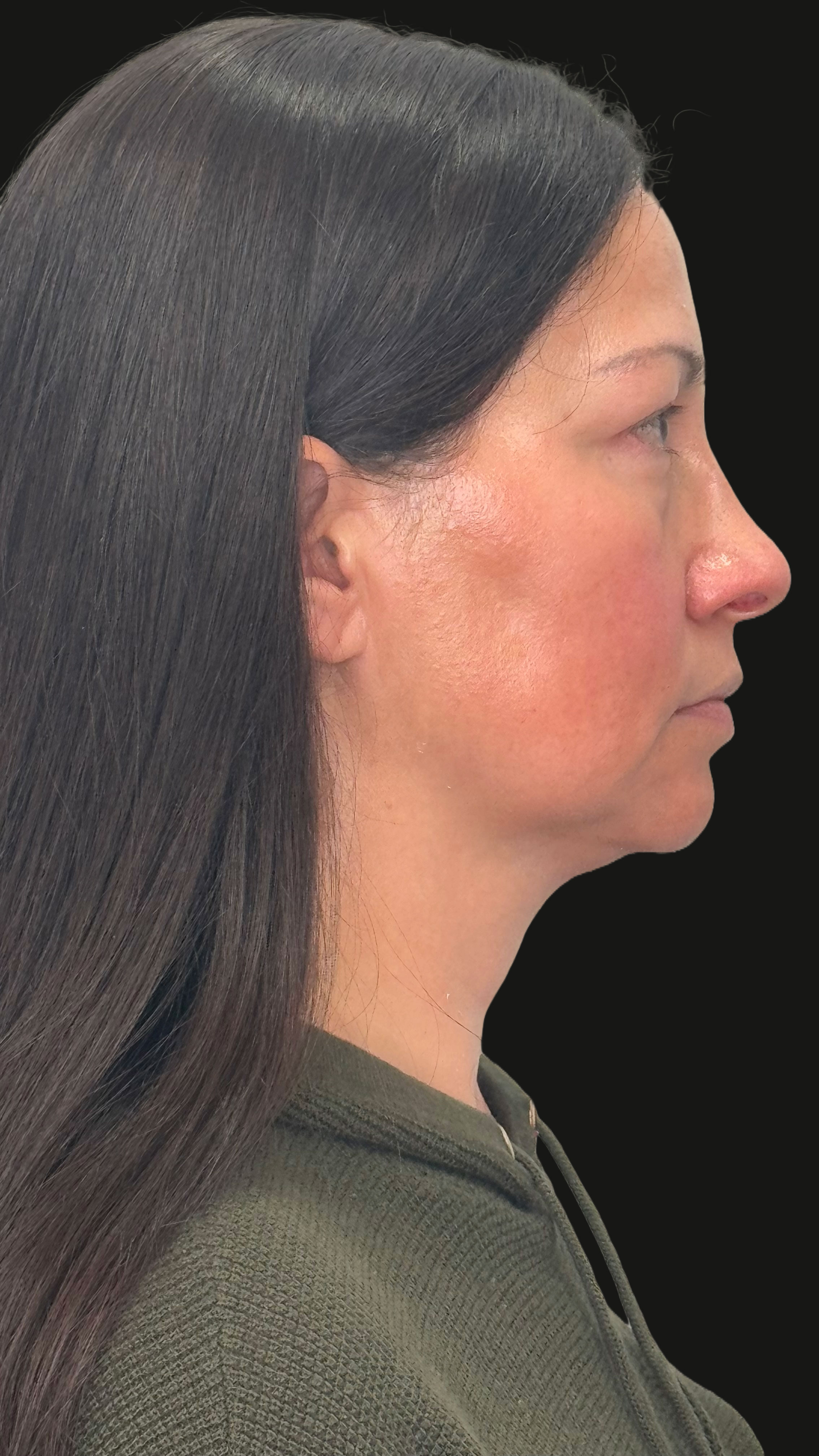 Facelift Before & After Image