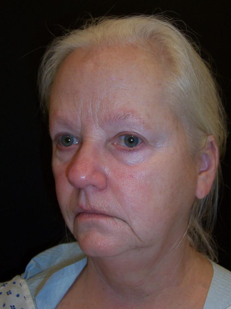 Facial Fat Grafting Before & After Image