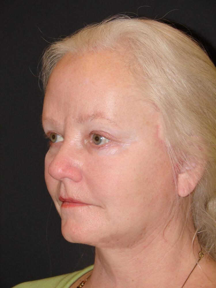 Facial Fat Grafting Before & After Image