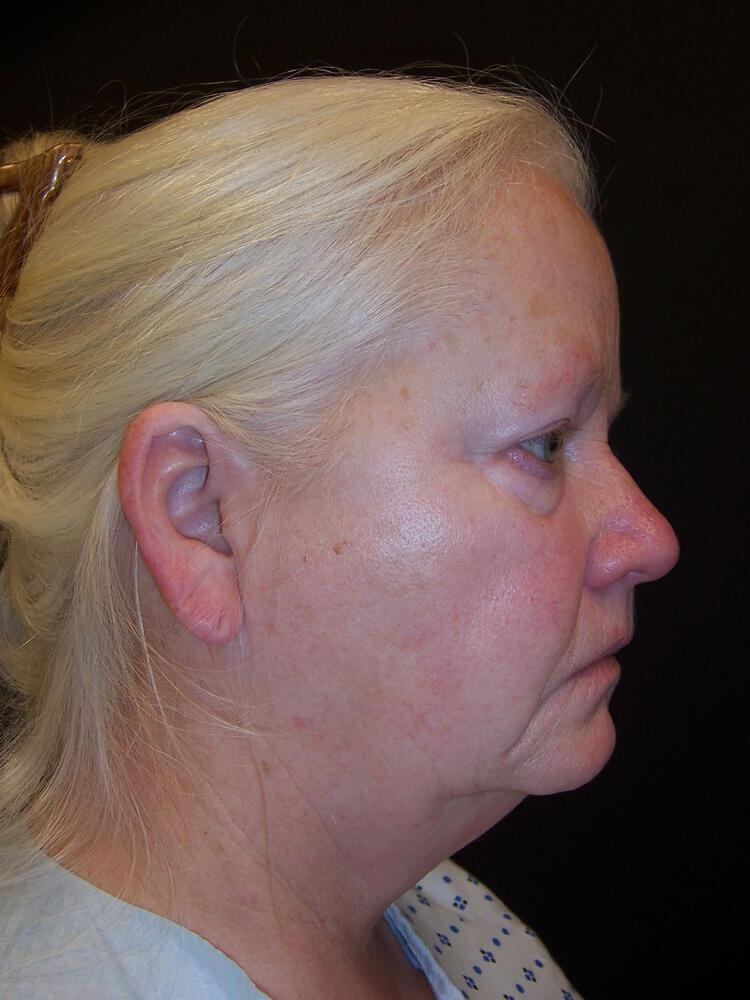 Facial Fat Grafting Before & After Image