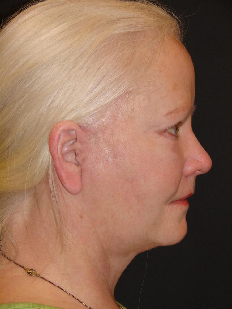 Facial Fat Grafting Before & After Image