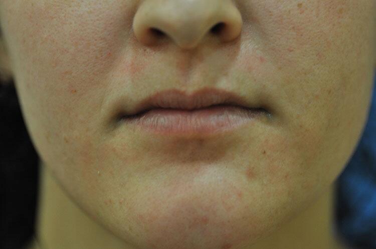 Lip Augmentation Before & After Image