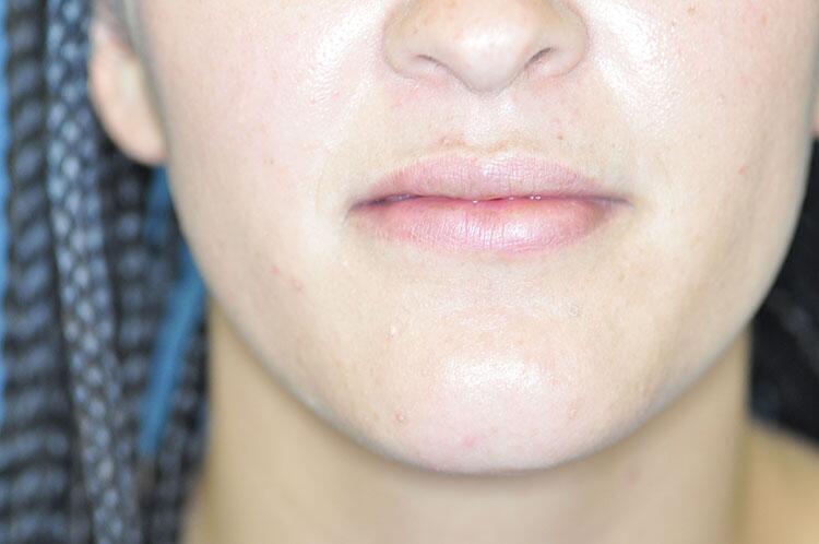 Lip Augmentation Before & After Image