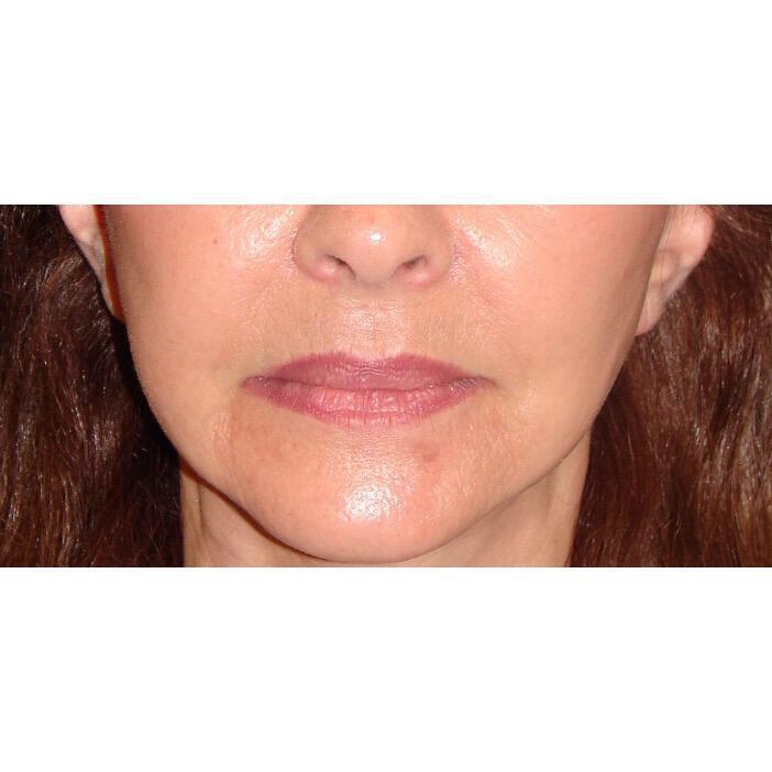 Lip Augmentation Before & After Image