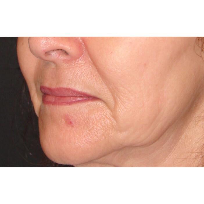 Lip Augmentation Before & After Image