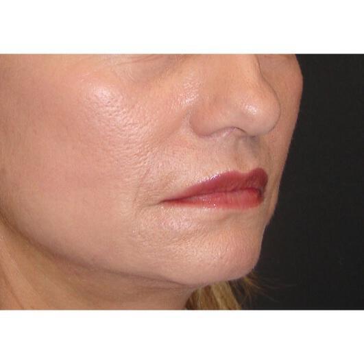 Lip Augmentation Before & After Image