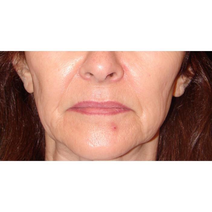 Lip Lift Before & After Image