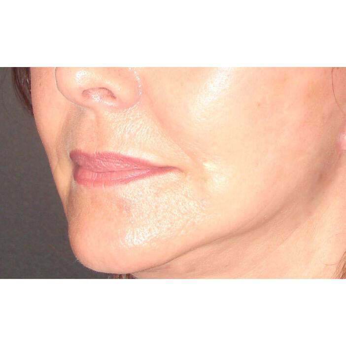 Lip Lift Before & After Image