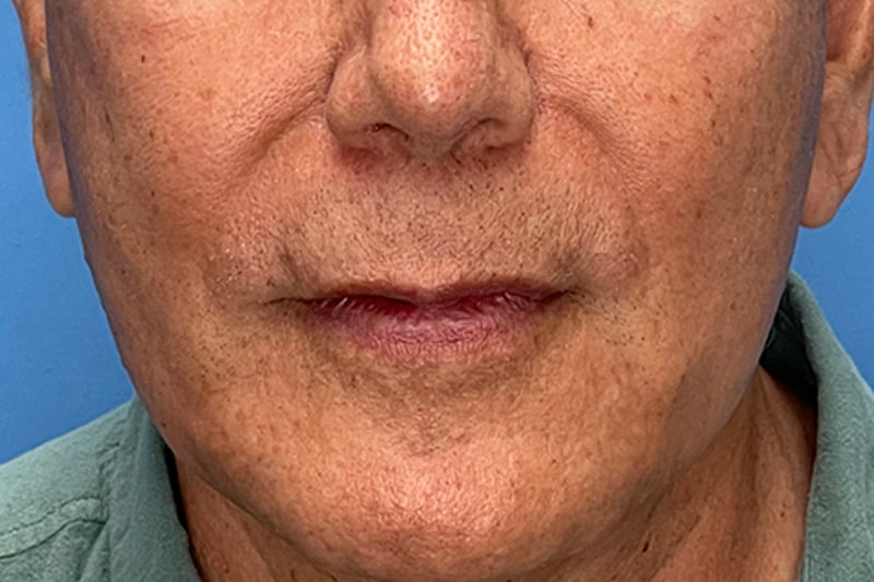 Lip Lift Before & After Image