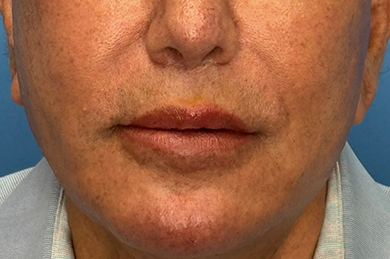 Lip Lift Before & After Image