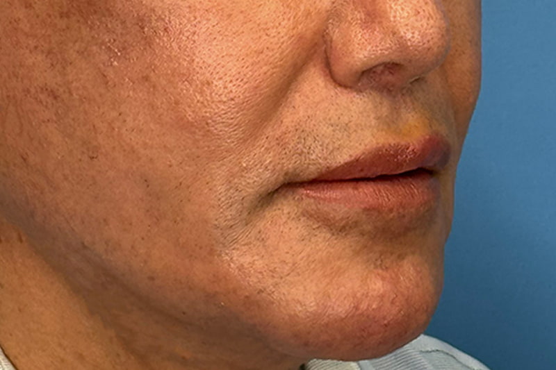 Lip Lift Before & After Image