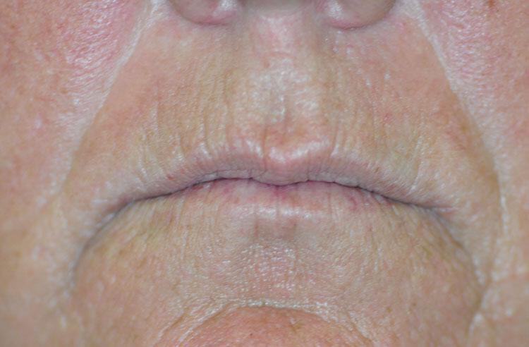 Lip Lift Before & After Image