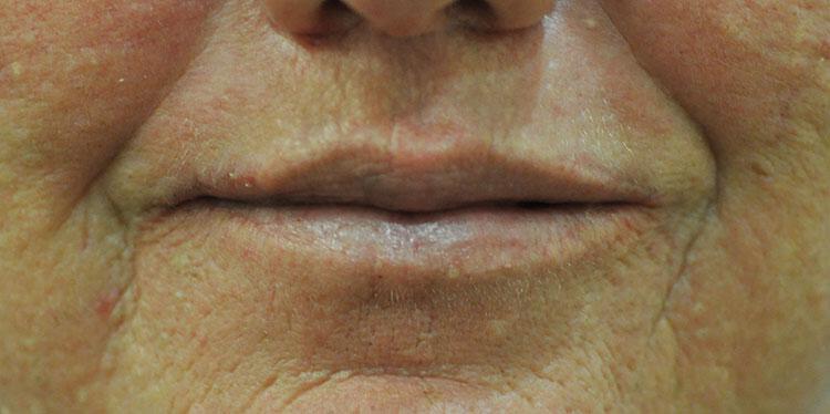 Lip Lift Before & After Image