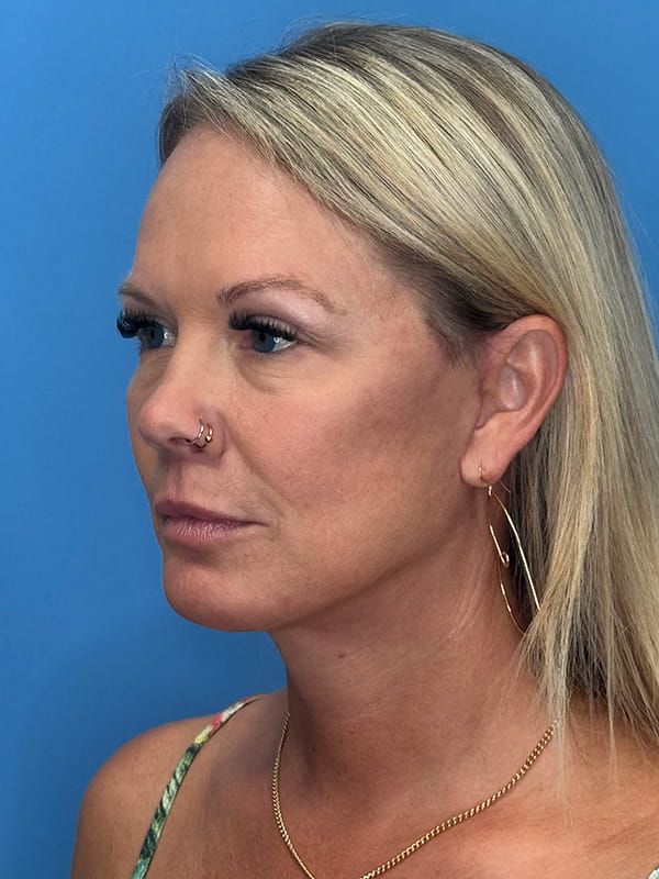 Lower Facelift<br>(SMAS Lift) Before & After Image
