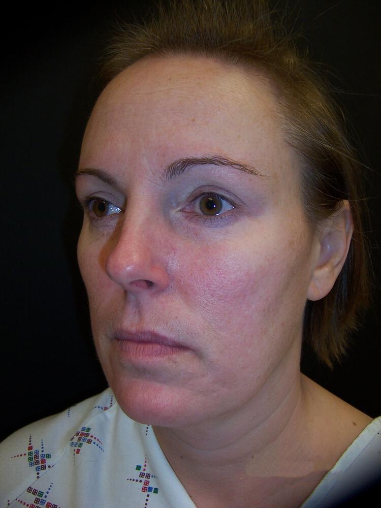 Mini Facelift Before & After Image