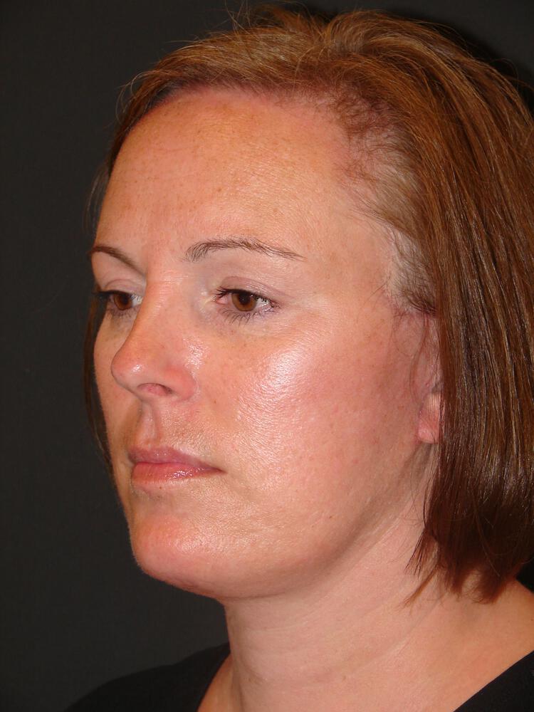 Mini Facelift Before & After Image