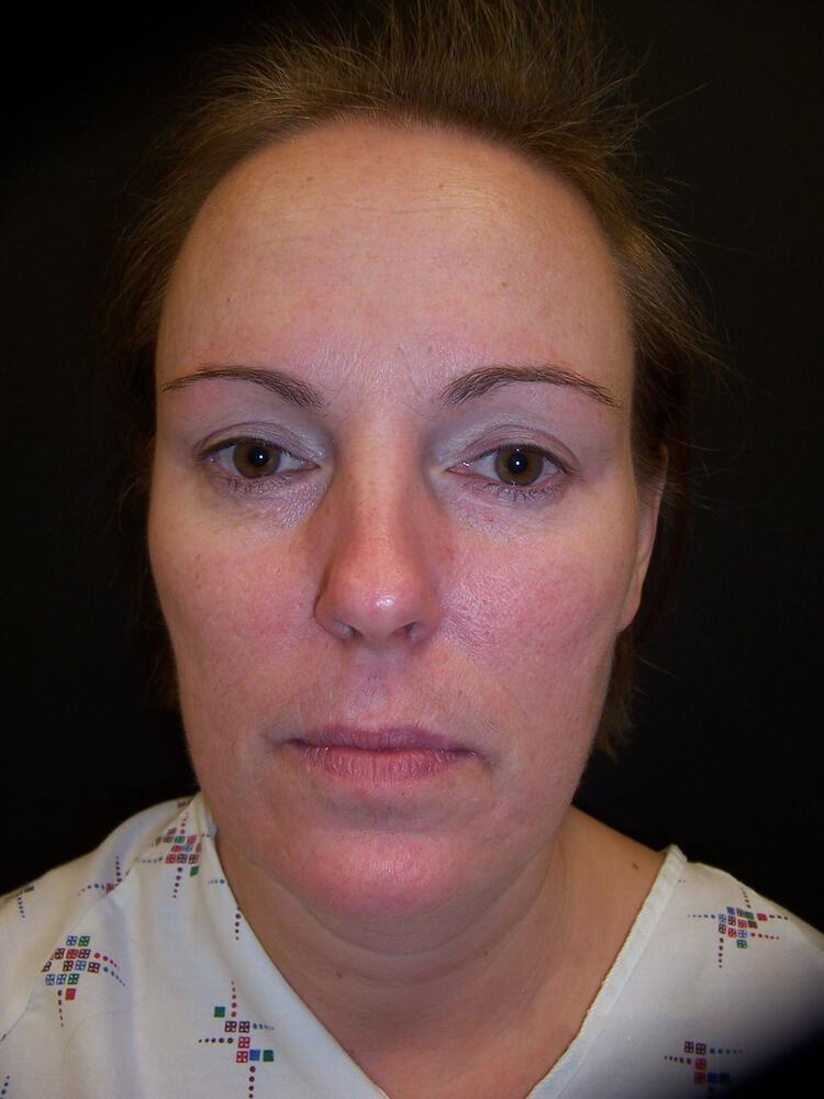 Mini Facelift Before & After Image