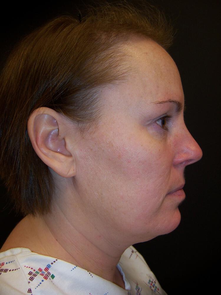 Mini Facelift Before & After Image