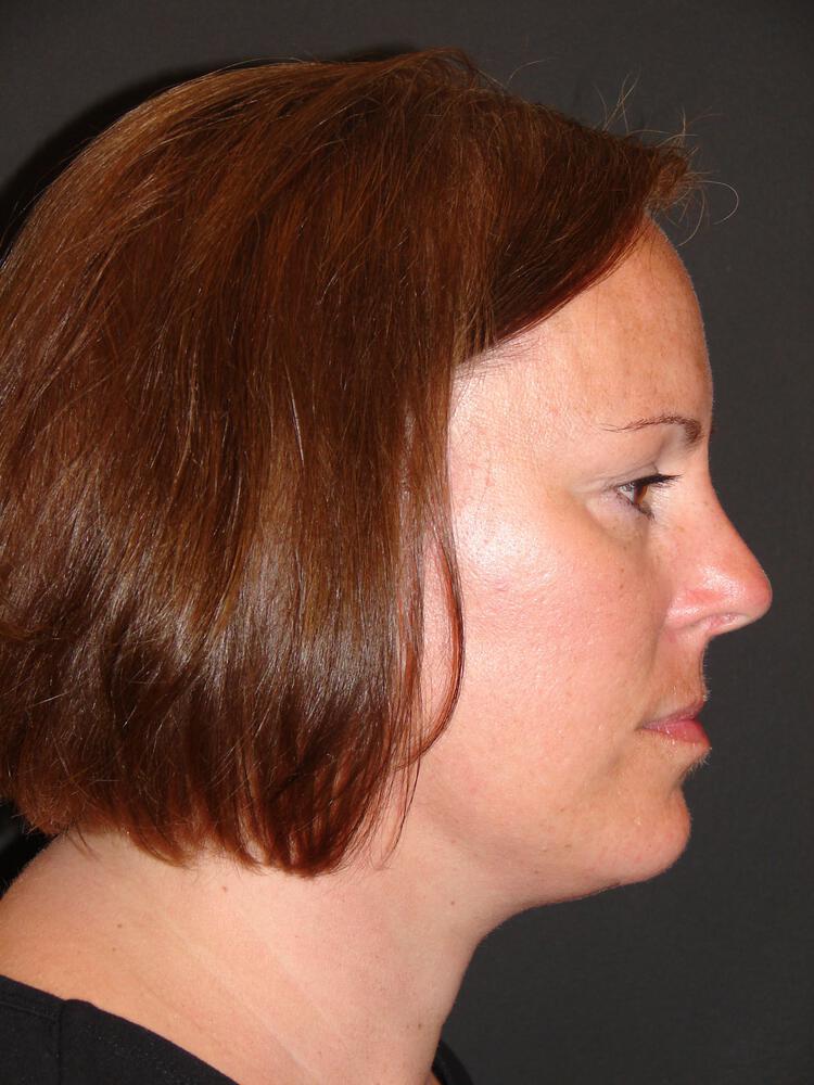 Mini Facelift Before & After Image