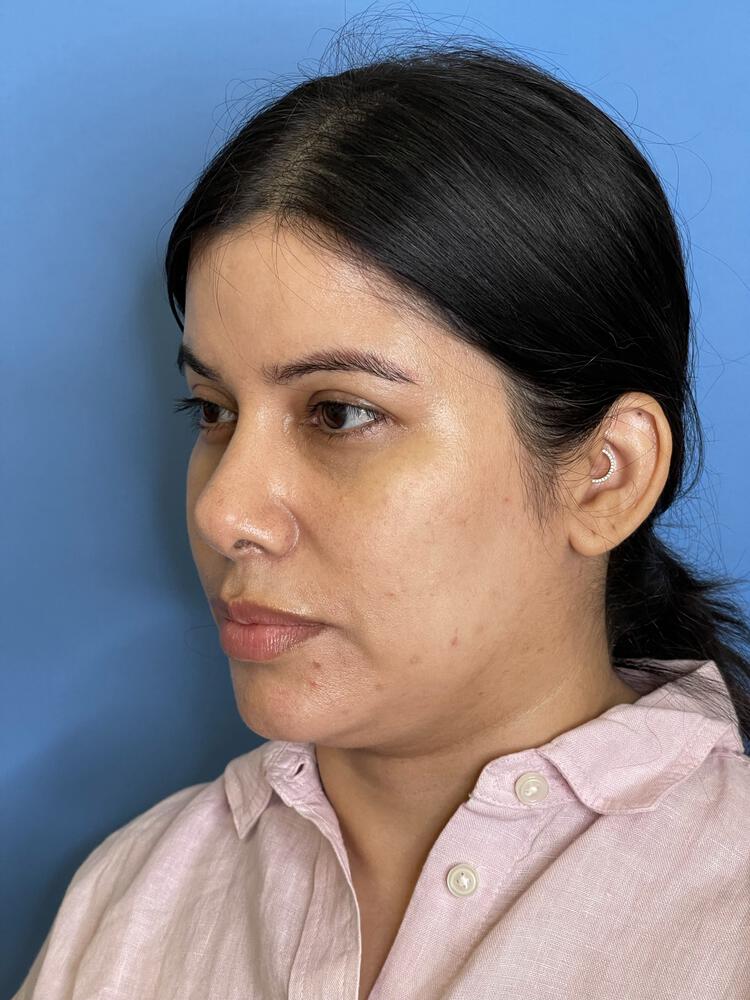 Mini Facelift Before & After Image